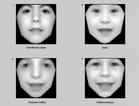 Nét mặt “tố” bệnh di truyền?