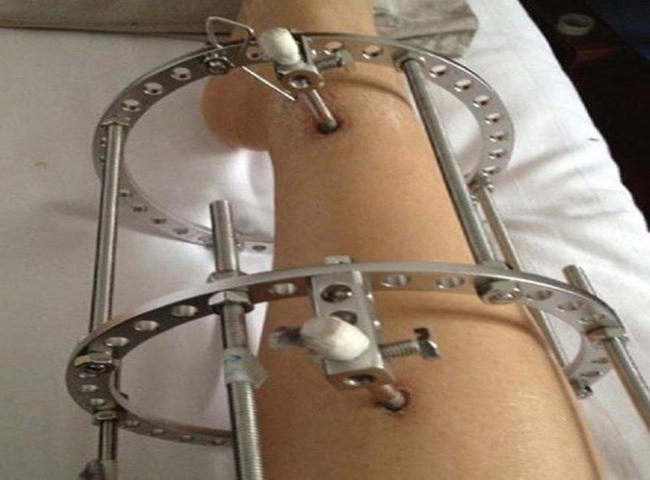 Cực hình của “kéo” và “kéo quá đà” để có chân dài