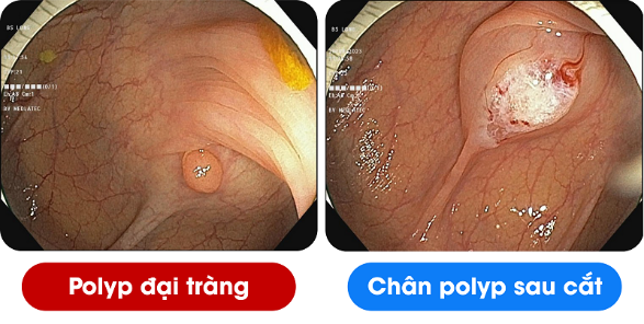 3 công bố mới nhất về phương pháp cắt lạnh polyp đại tràng 