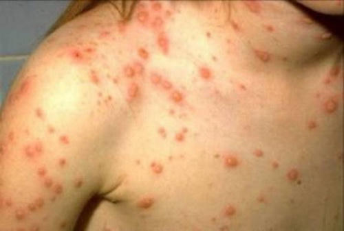 Ban thủy đậu là ban bọc nước, mọc toàn thân còn ban sởi là ban nhỏ mỏng trên mặt da, mọc theo thứ tự mặt, lan xuống chân.