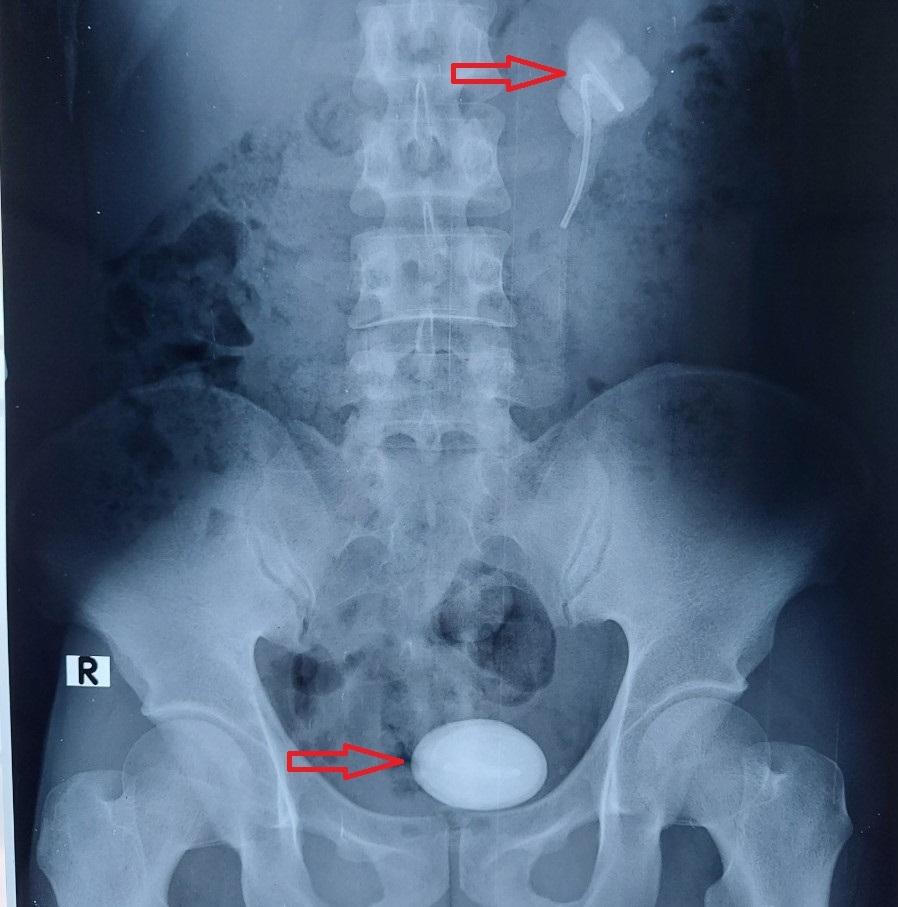 Lấy sỏi to như quả trứng ra khỏi người bệnh quên tái khám