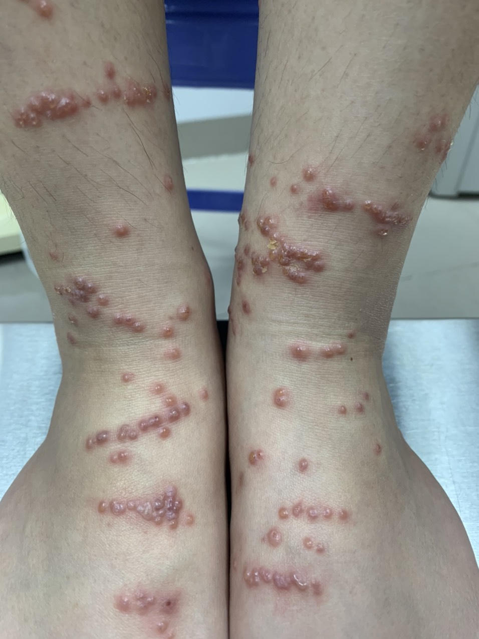 Đi tắm biển, bé trai bị sứa "tấn công"