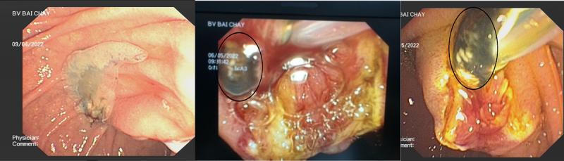 Người đàn ông tắc ống mật do sán lá gan