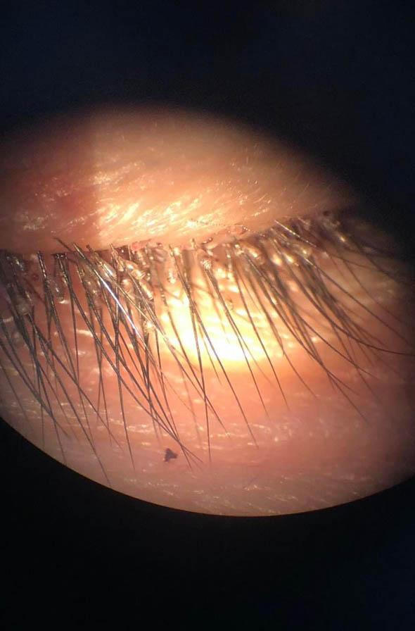 Kinh hoàng gần 100 con rận làm tổ trên mi mắt người đàn ông