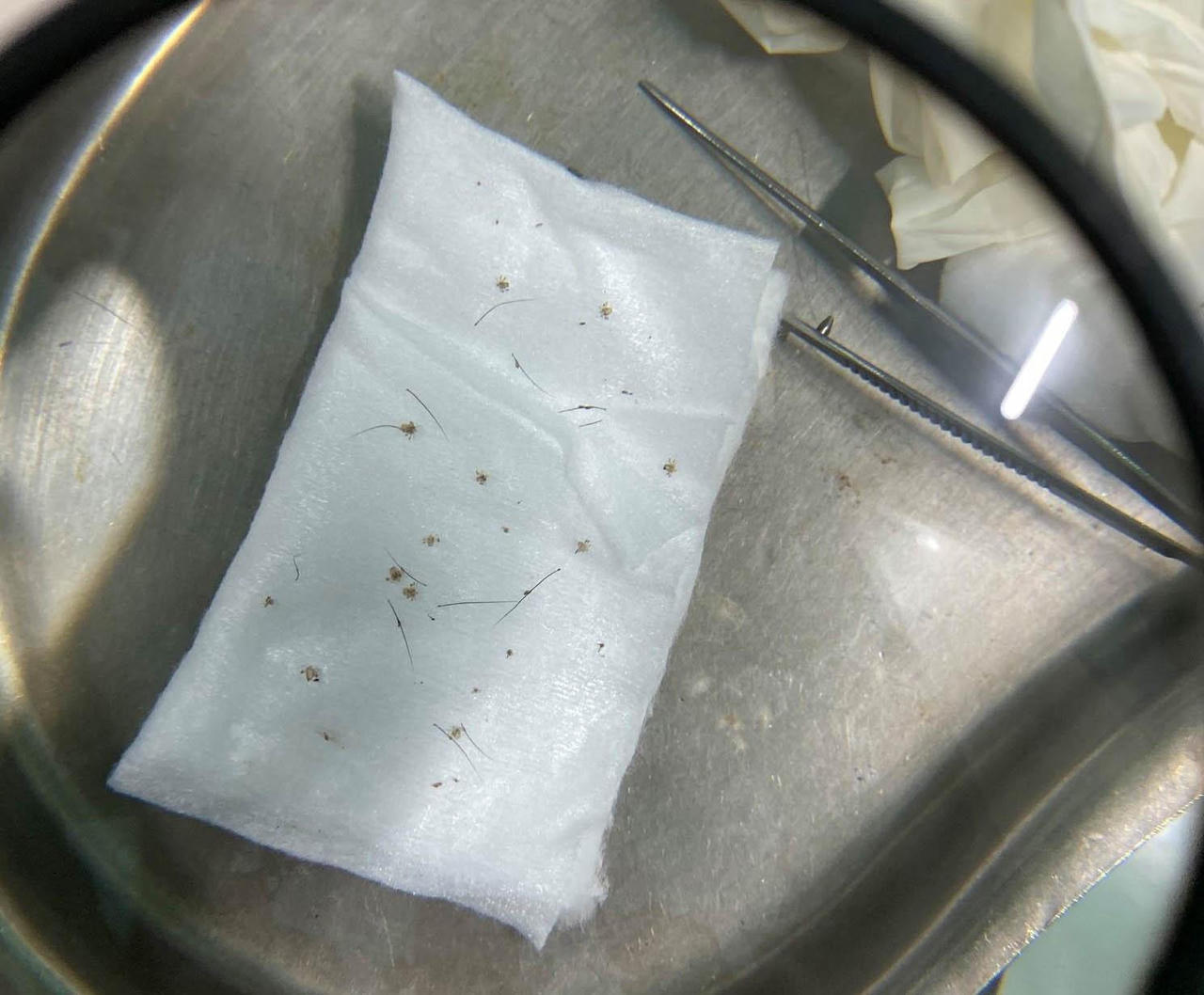 Kinh hoàng gần 100 con rận làm tổ trên mi mắt người đàn ông