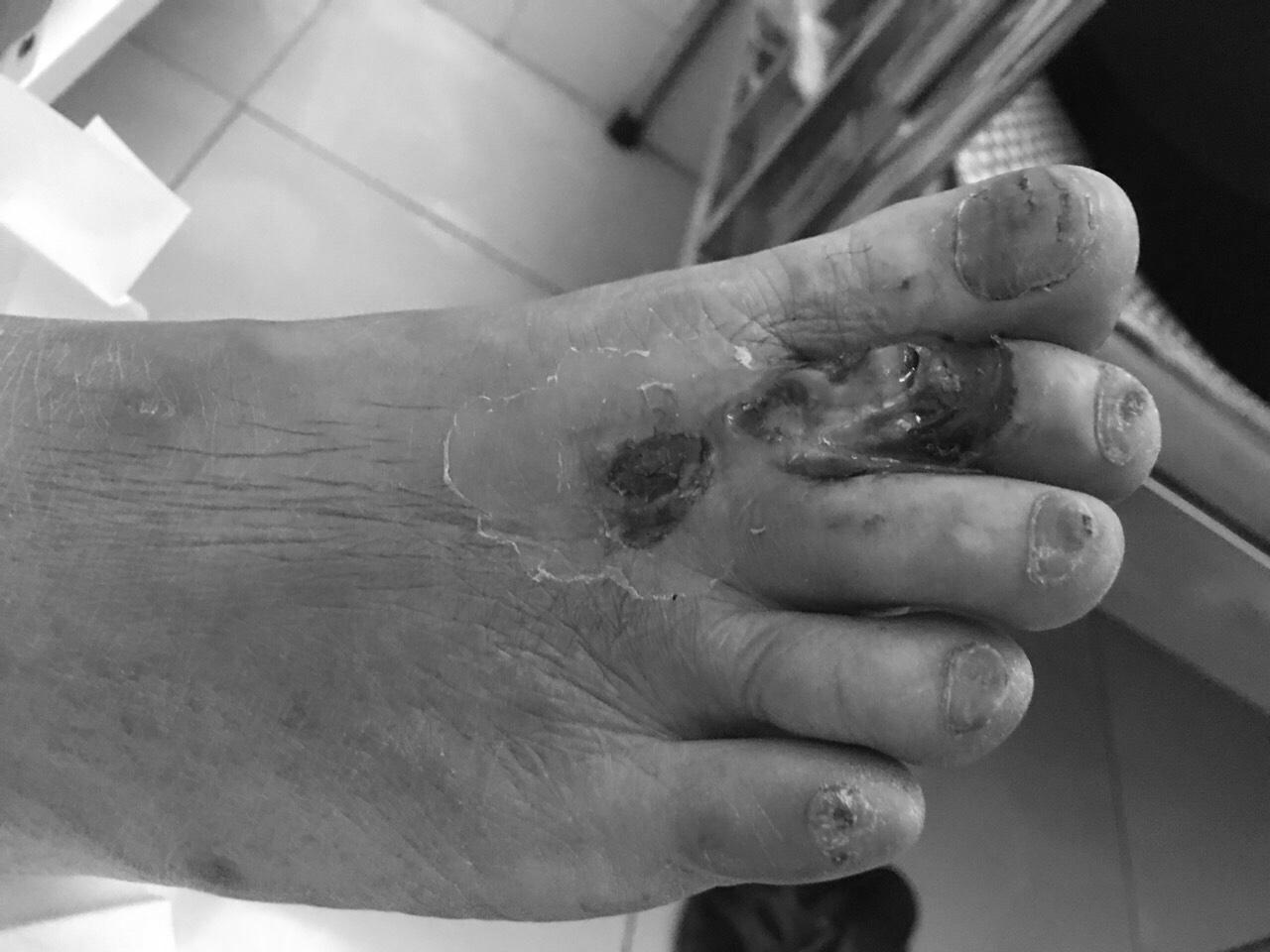 Phải cắt bỏ ngón chân vì tự đắp thuốc chữa tiểu đường