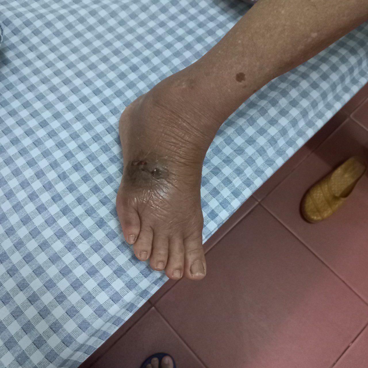 Cụ bà bị chuột cắn hoại tử chân