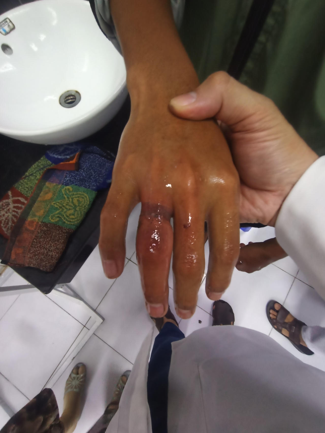 Hai trẻ suýt hoại tử ngón tay do đeo nhẫn giá rẻ trên mạng