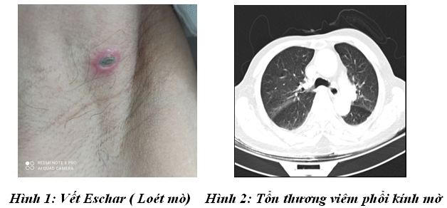 Người đàn ông sốt liền 7 ngày do mò đốt