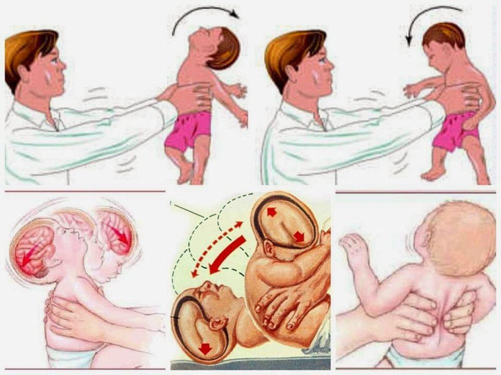 Người lớn bế xốc nách và rung lắc, trẻ 4 tháng tuổi bị xuất huyết não