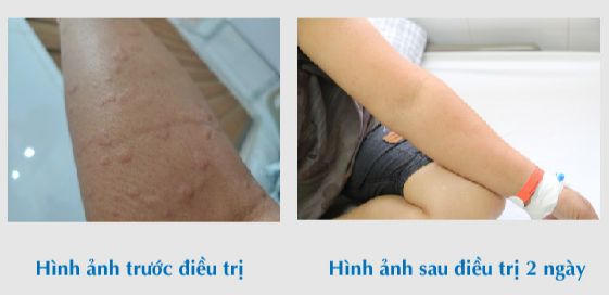 Người phụ nữ nhập viện khẩn cấp sau khi bị... kiến đốt 