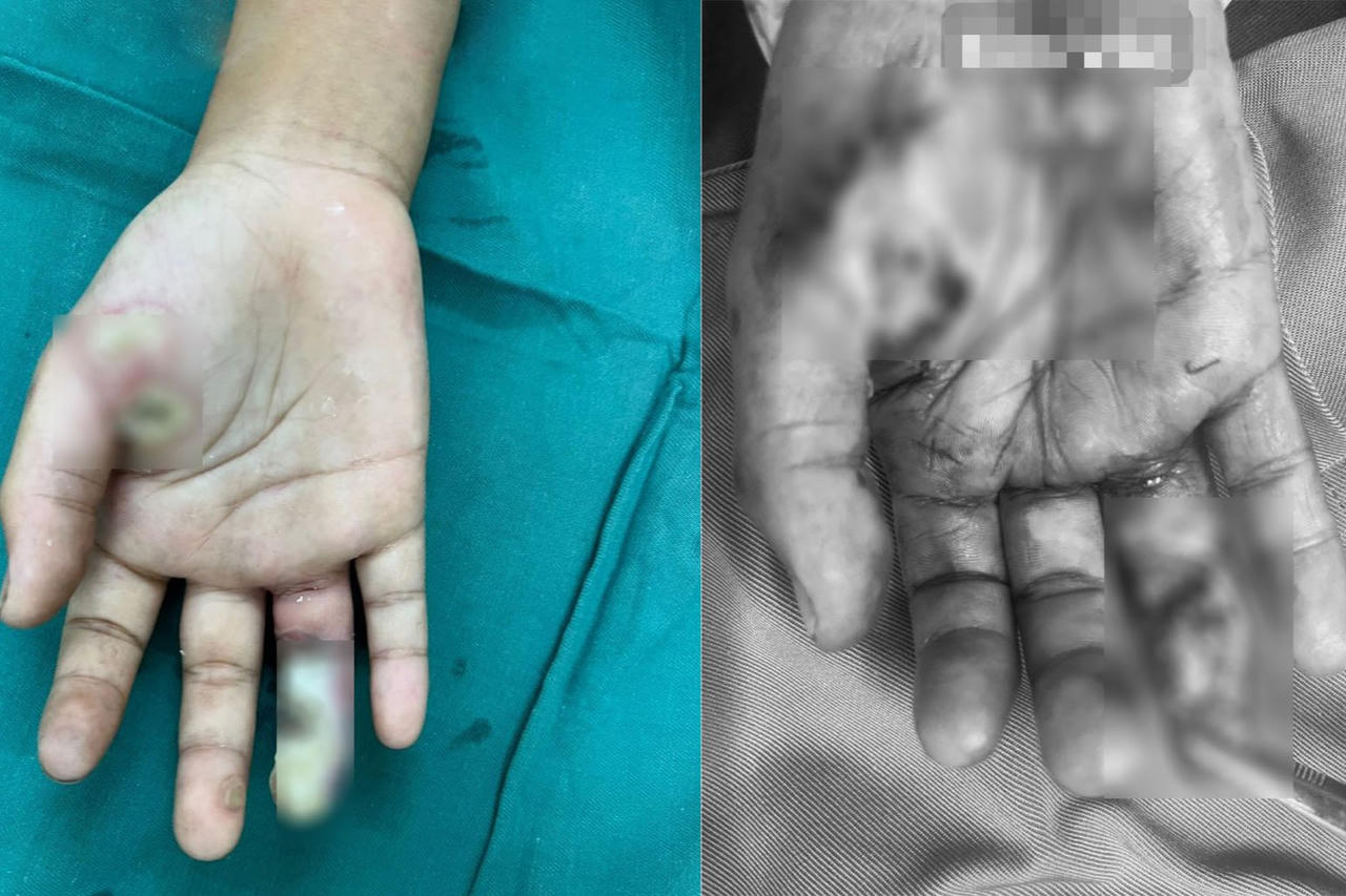 Nối ngón tay vào bụng giúp 2 bé bị điện giật không phải cắt cụt chi 