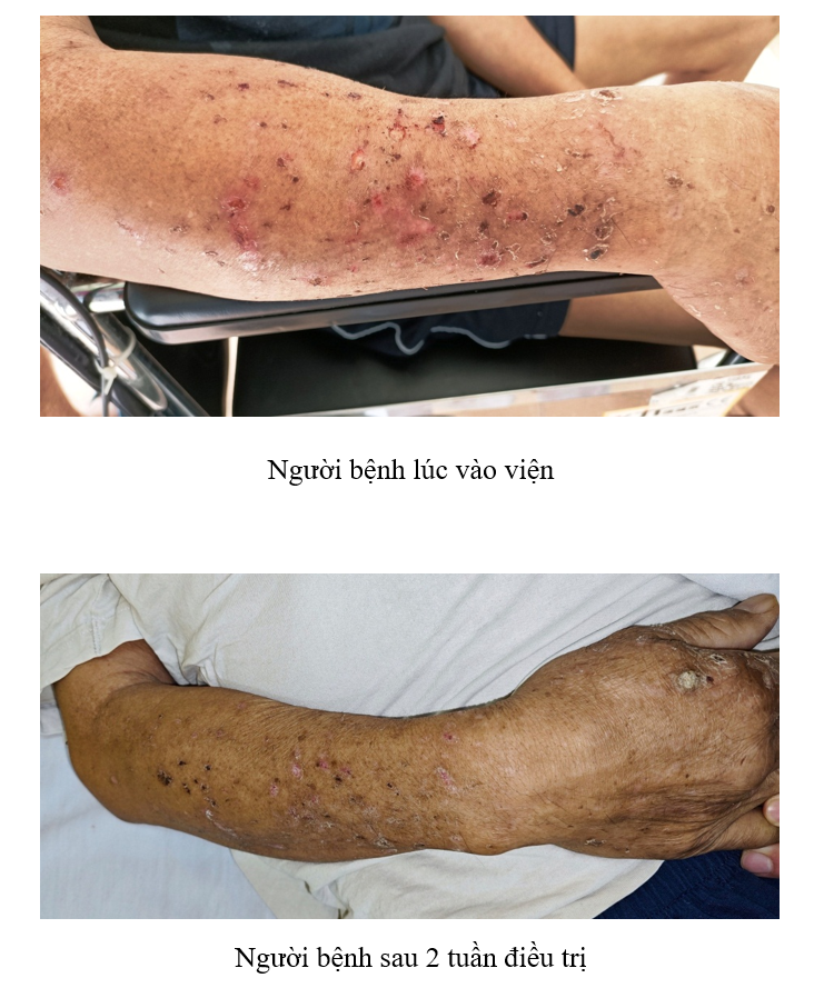 Người đàn ông bị tâm thần sau điều trị đột quỹ não