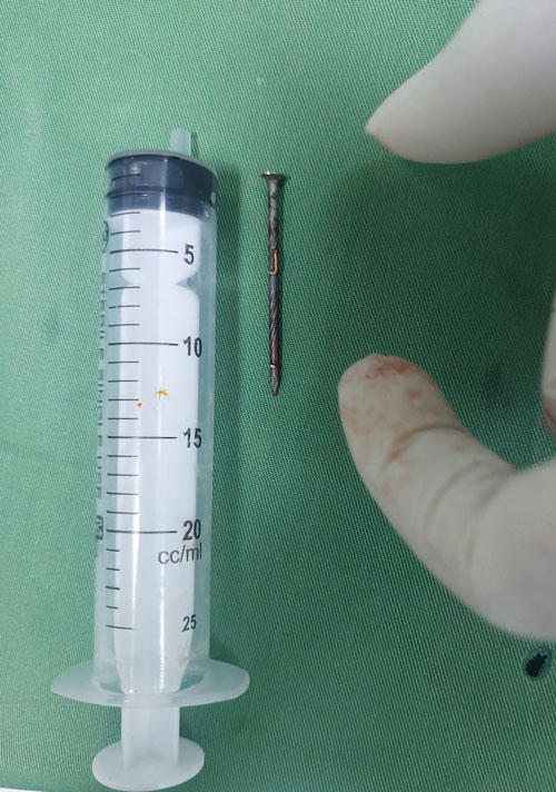 Nam thanh niên bị đinh xuyên vào đầu khi làm việc nhà