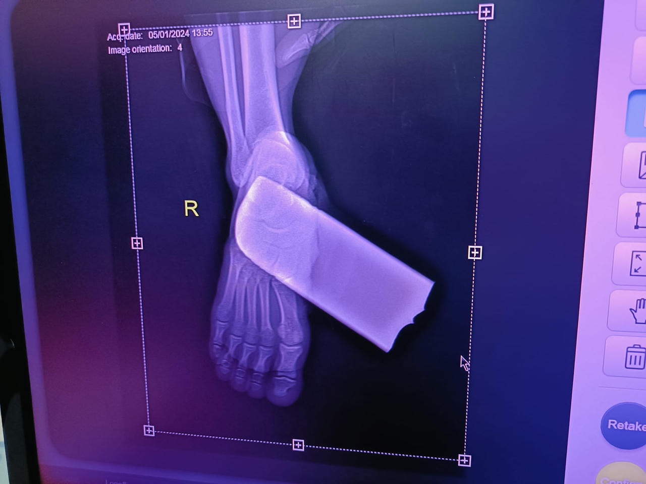 Cứu 2 người bị máy cắt cỏ chém đứt cẳng tay, chân