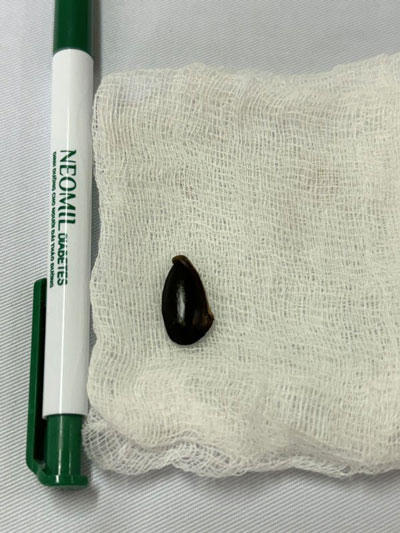 Người phụ nữ 'cầu cứu' bác sĩ sau ăn quả hồng xiêm