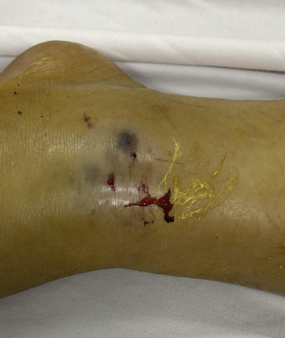 2 trẻ ở miền Tây bị rắn và bọ cạp cắn nguy kịch