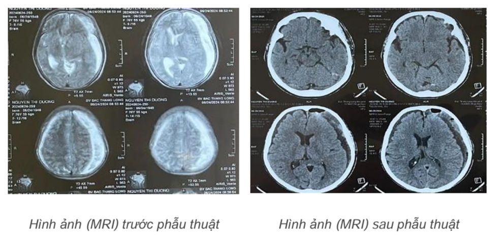Kịp thời cứu sống cụ bà, bác sĩ khuyến cáo những biểu hiện nhà có người già cần lưu ý