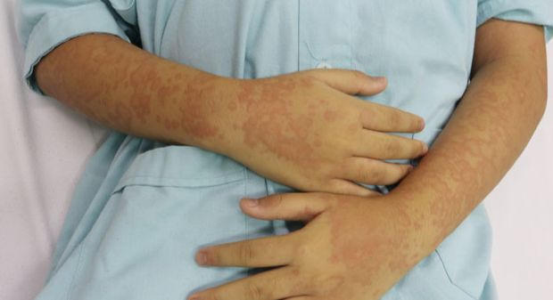 Bé gái nhập viện sau ăn con cù kỳ