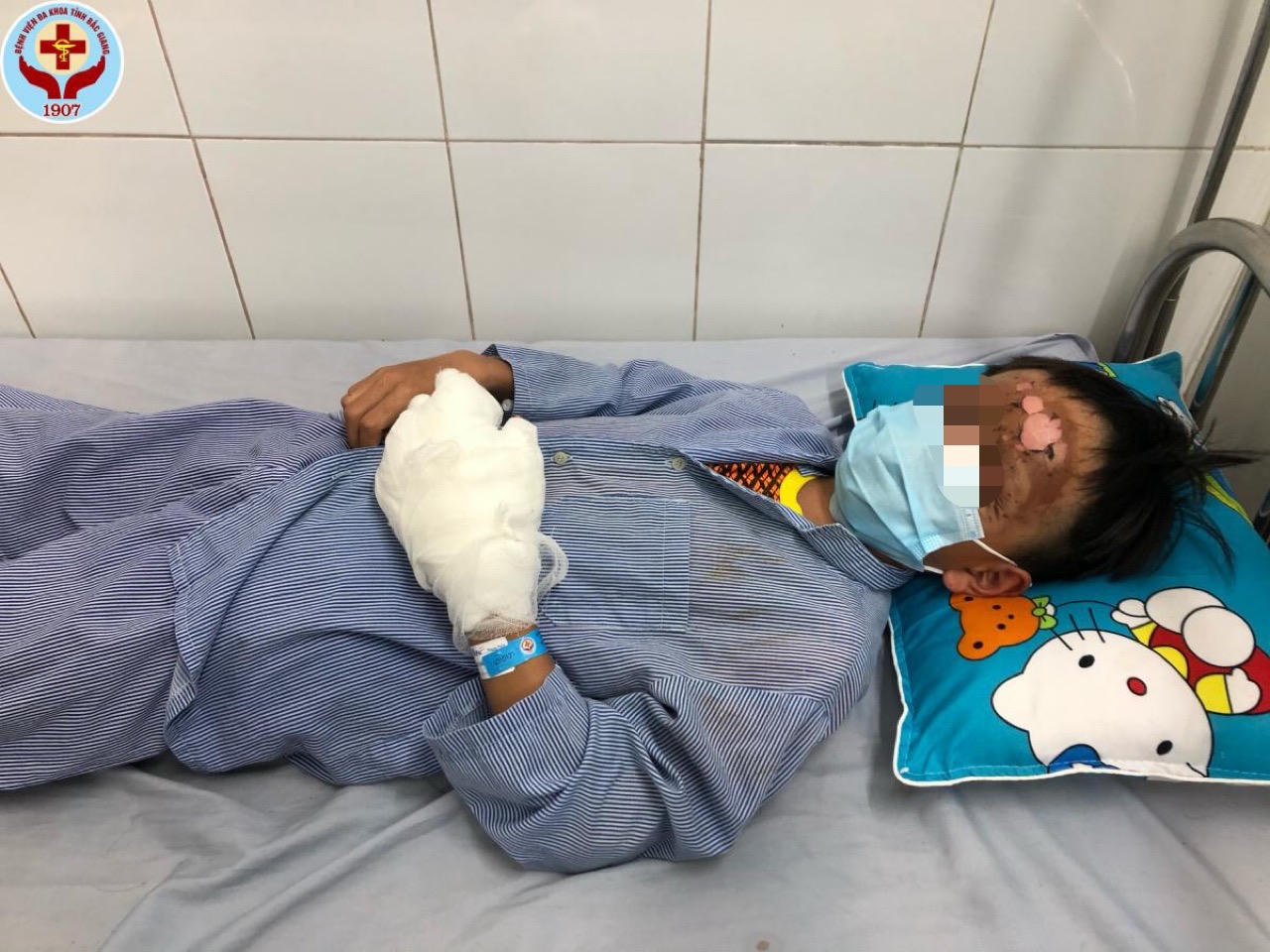 Hai bé trai bị bỏng nặng do nổ pháo tự chế