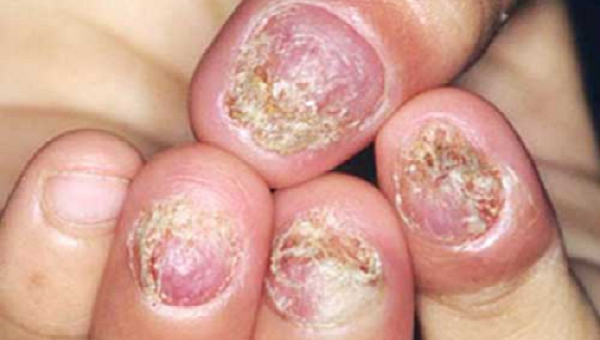 Trời nồm ẩm, cẩn thận bệnh nấm da