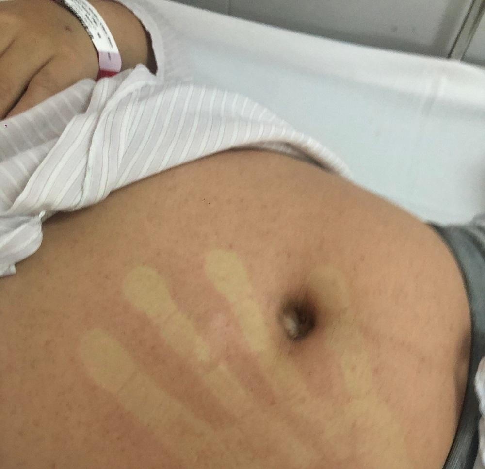 Tưởng phản ứng sau tiêm vaccine phòng COVID-19, người đàn ông đi khám phát hiện sốt xuất huyết