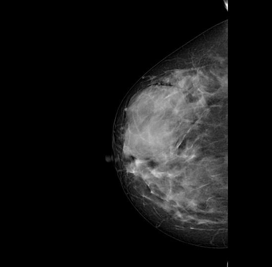 Cảnh giác với “chiêu” quảng cáo nâng ngực không cần phẫu thuật