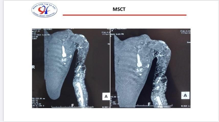 Thiếu niên 17 tuổi có cánh tay trái rỗ như tổ ong