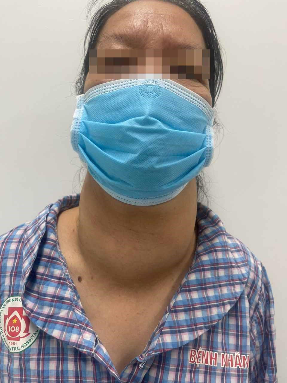 Người phụ nữ có khối u tuyến giáp khổng lồ 