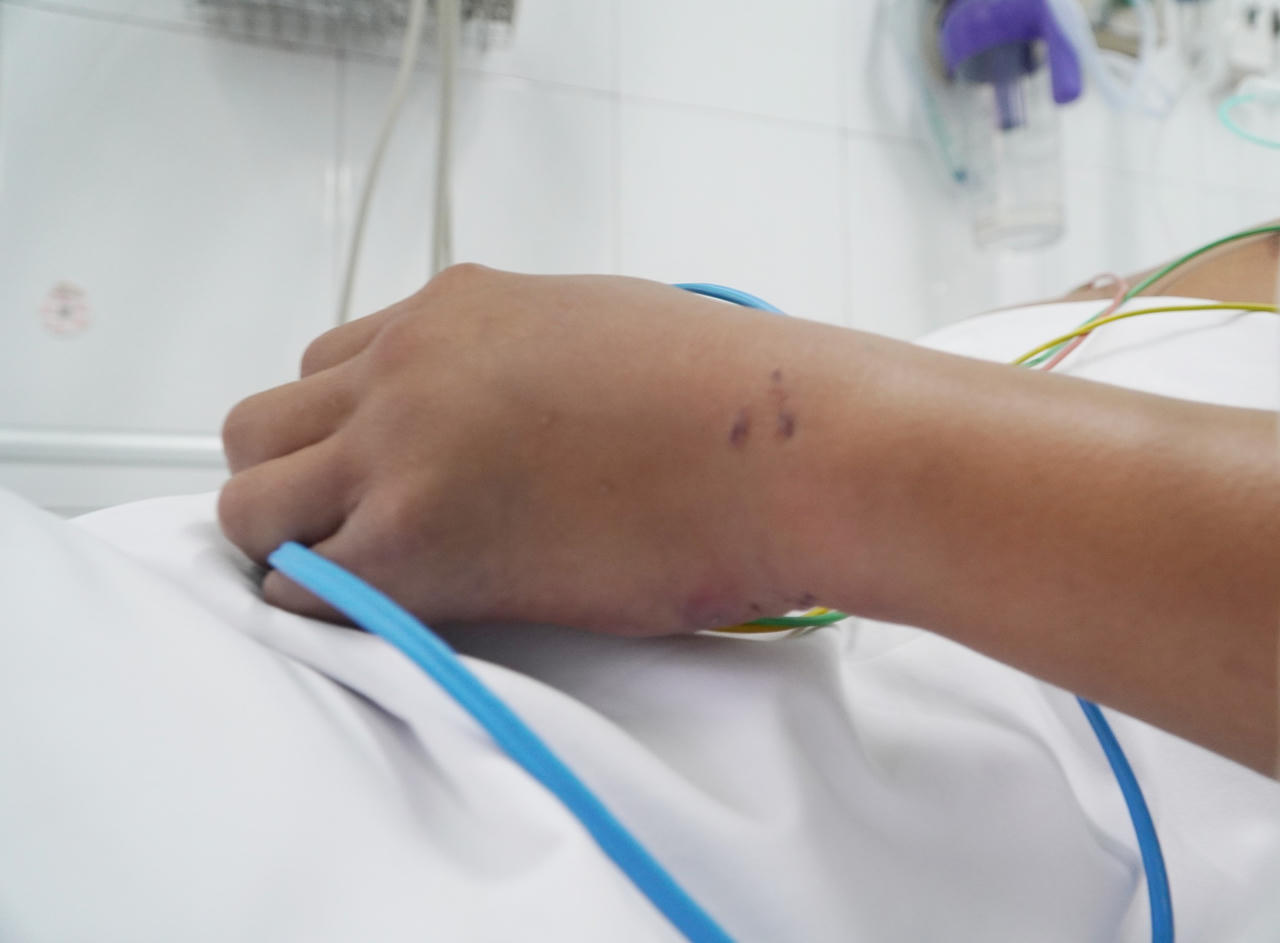 Truyền 10 lọ huyết thanh để cứu người đàn ông bị rắn hổ chúa cắn 