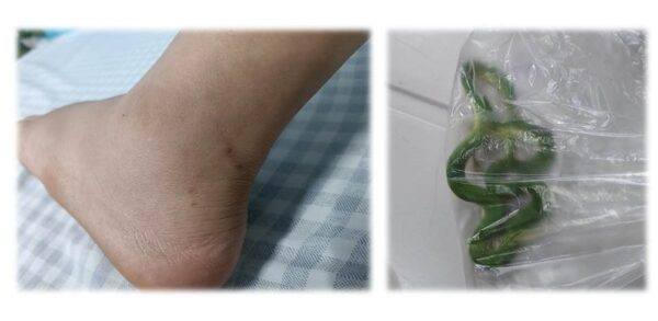 Truyền 70 lọ huyết thanh cấp cứu 3 bệnh nhân bị rắn cắn