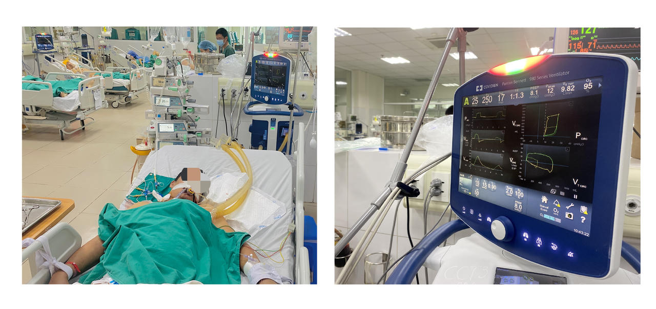 Chạy đua cứu bệnh nhân suy đa tạng do sốt xuất huyết 