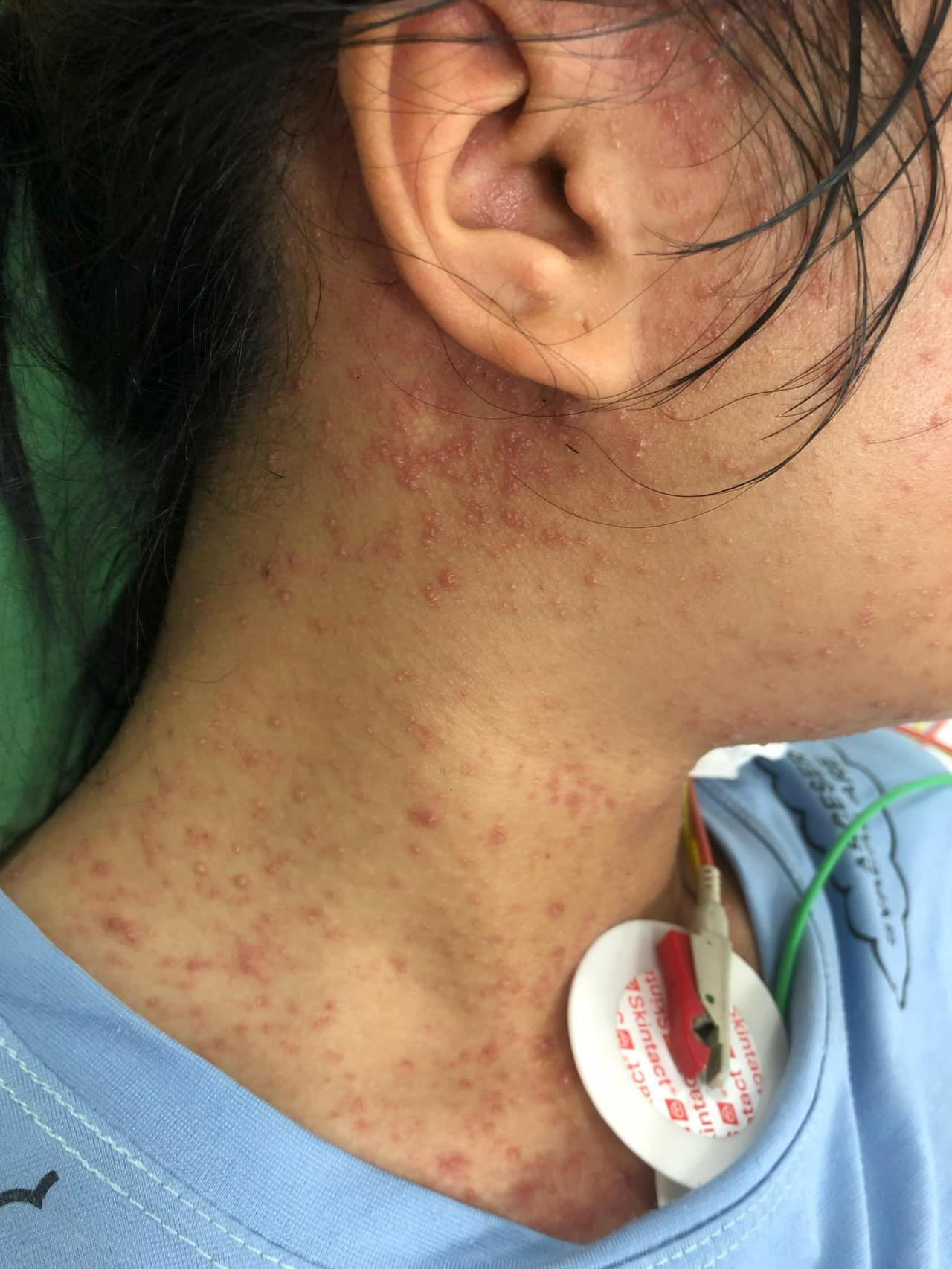 Suýt tử vong vì mắc căn bệnh thường gặp rồi đi uống thuốc nam