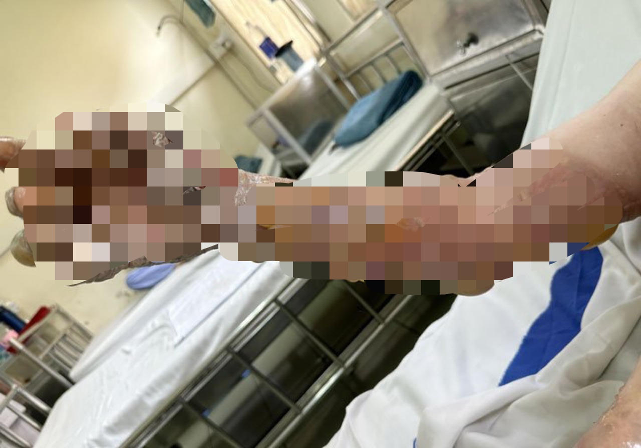 Hai người đàn ông đi cấp cứu sau khi đốt rác