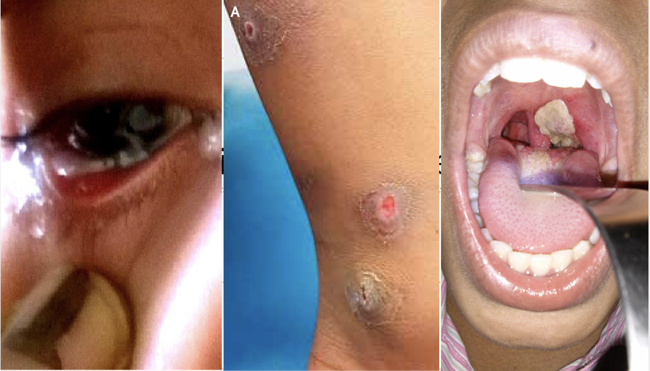 Bệnh bạch hầu nguy hiểm như thế nào?