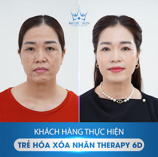 Công nghệ trẻ hoá, xoá nhăn Therart 6D tại Medic Skin - ‘Đánh thức’ làn da lão hoá