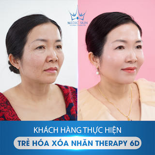 Công nghệ trẻ hoá, xoá nhăn Therart 6D tại Medic Skin - ‘Đánh thức’ làn da lão hoá