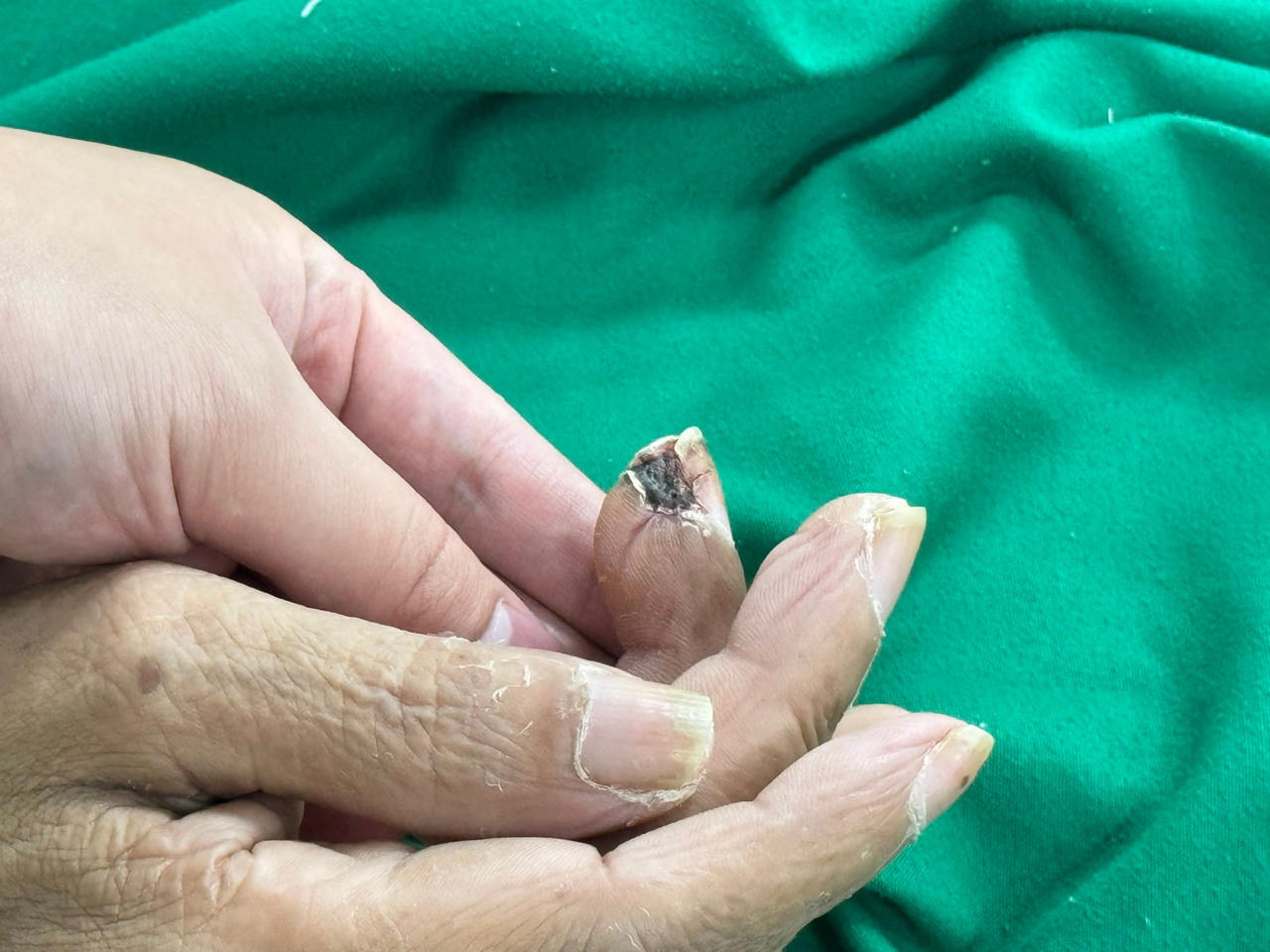 Mối nguy từ những vết thương hở