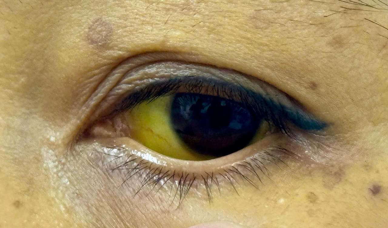 Da vàng như nghệ, nguy kịch vì tự uống thuốc nam chữa bệnh