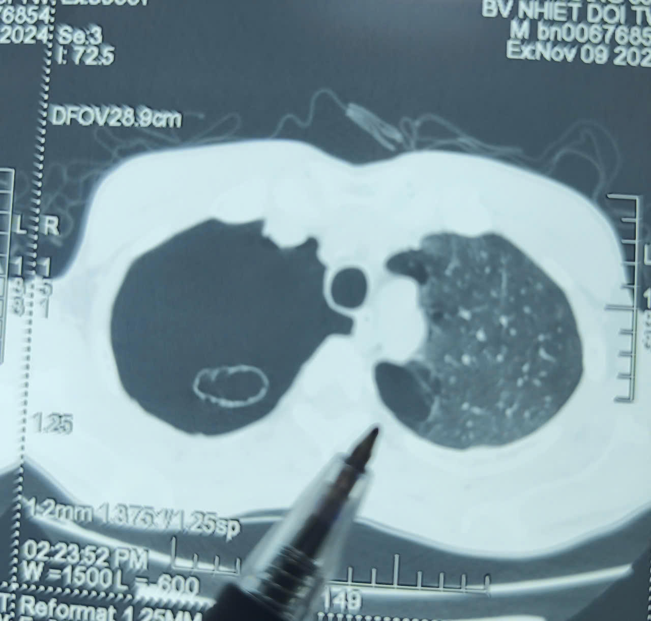 Nhập viện cấp cứu, điều trị tâm thần do hút thuốc