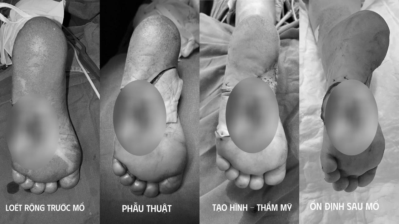 Bất ngờ phát hiện bệnh ung thư từ nốt đen ở bàn chân 