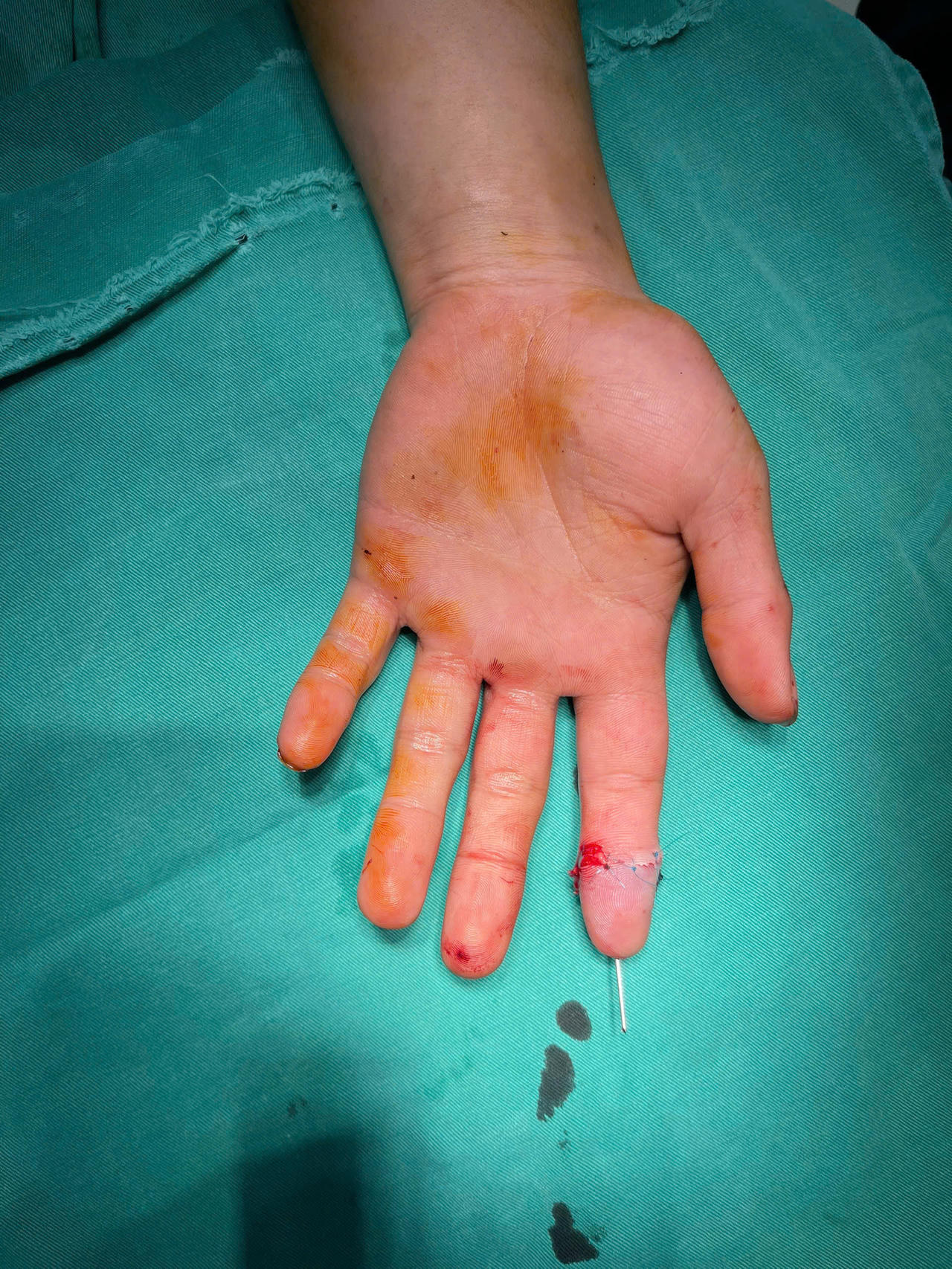 Vi phẫu nối liền đốt ngón tay cho người đàn ông bị tai nạn lao động 