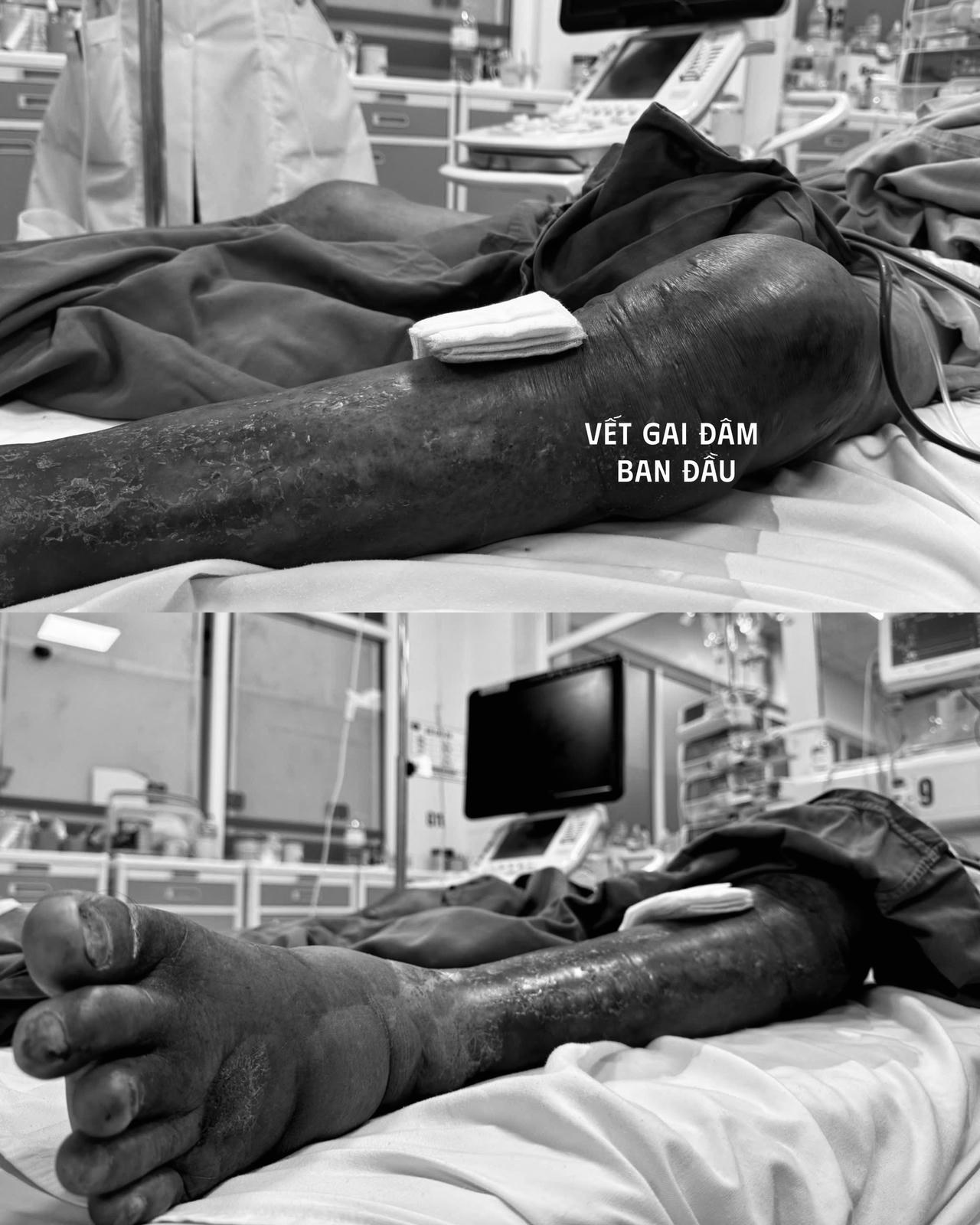 Người đàn ông nguy kịch sau khi bị gai đâm ở đầm tôm