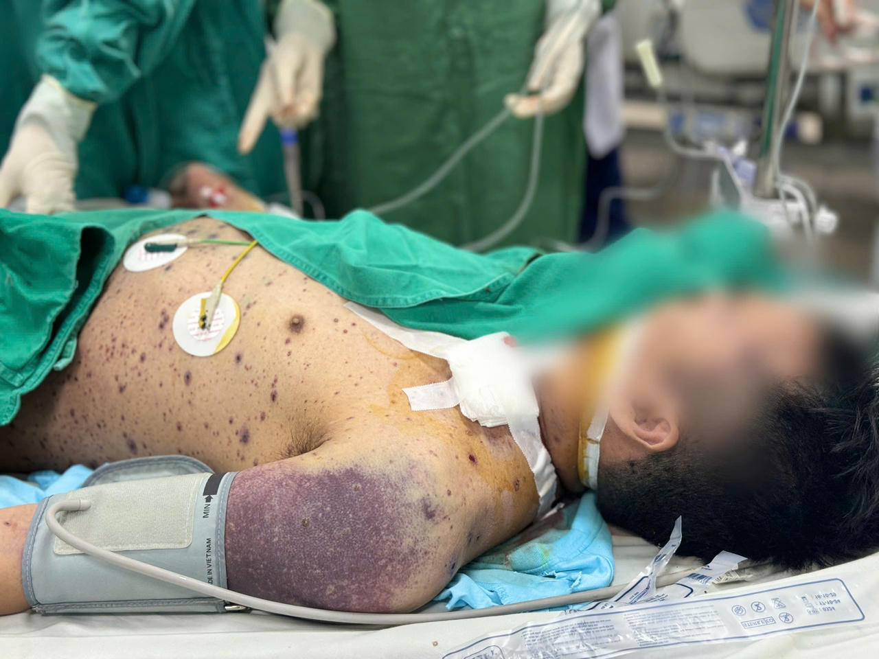 Nhiều người trẻ nguy kịch do mắc thủy đậu