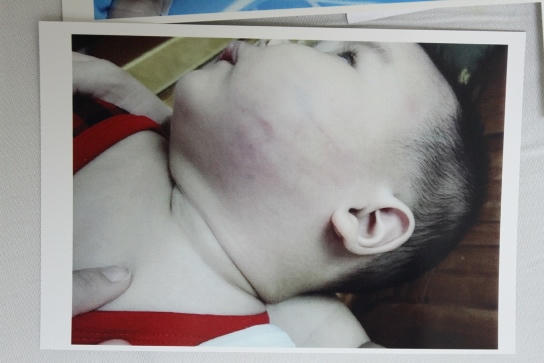 Đà Nẵng: Một cháu bé nhập viện nghi bị đánh ở nhà trẻ