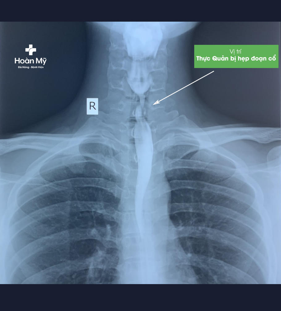 Một thanh niên uống nhầm chất tẩy rửa gây bỏng, hẹp thực quản