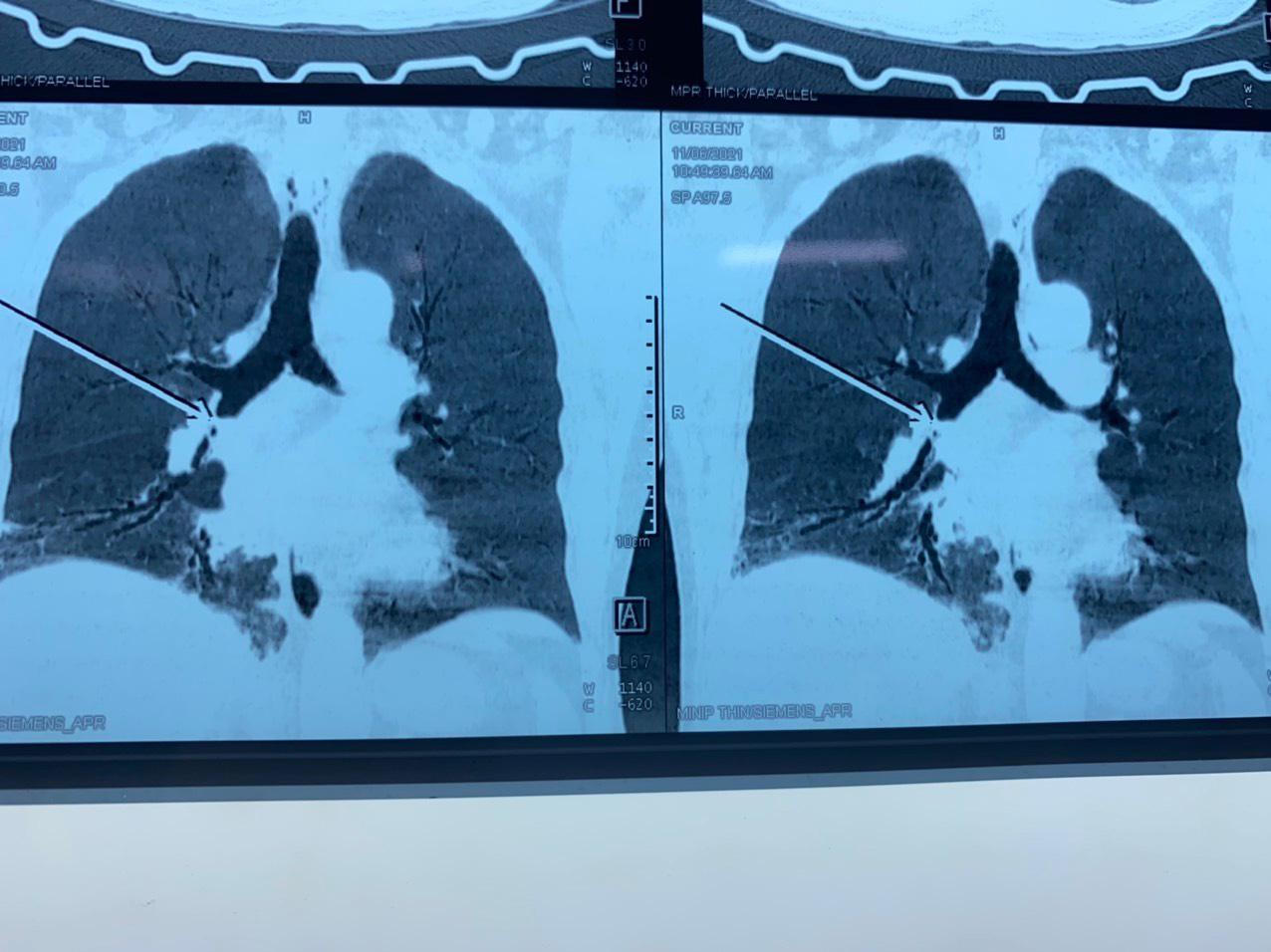 Nội soi gắp thành công mảnh xương nằm hơn một tháng trong phế quản