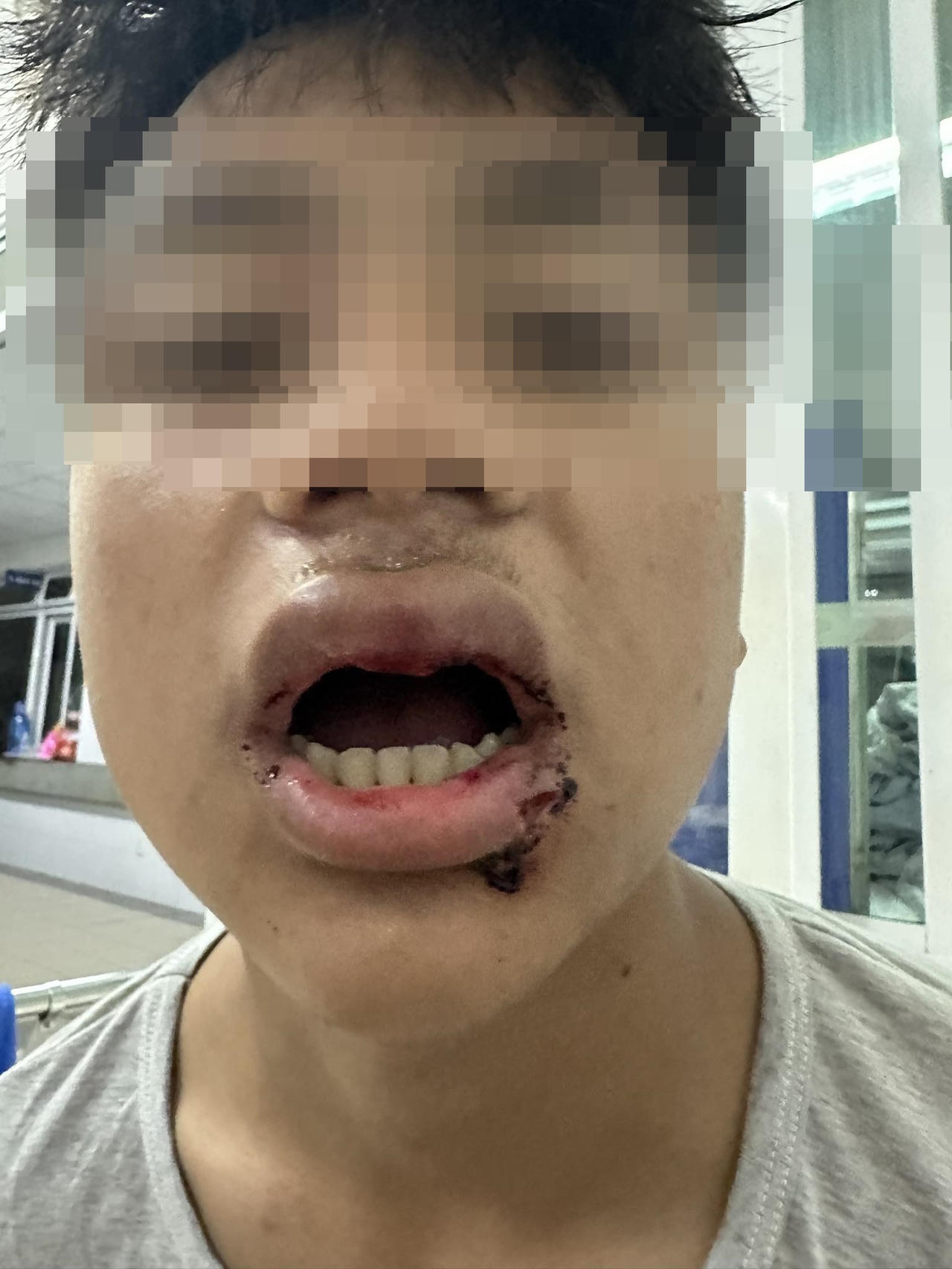 Nam sinh 14 tuổi bị đánh gãy nhiều răng khi tắm biển ở Đà Nẵng