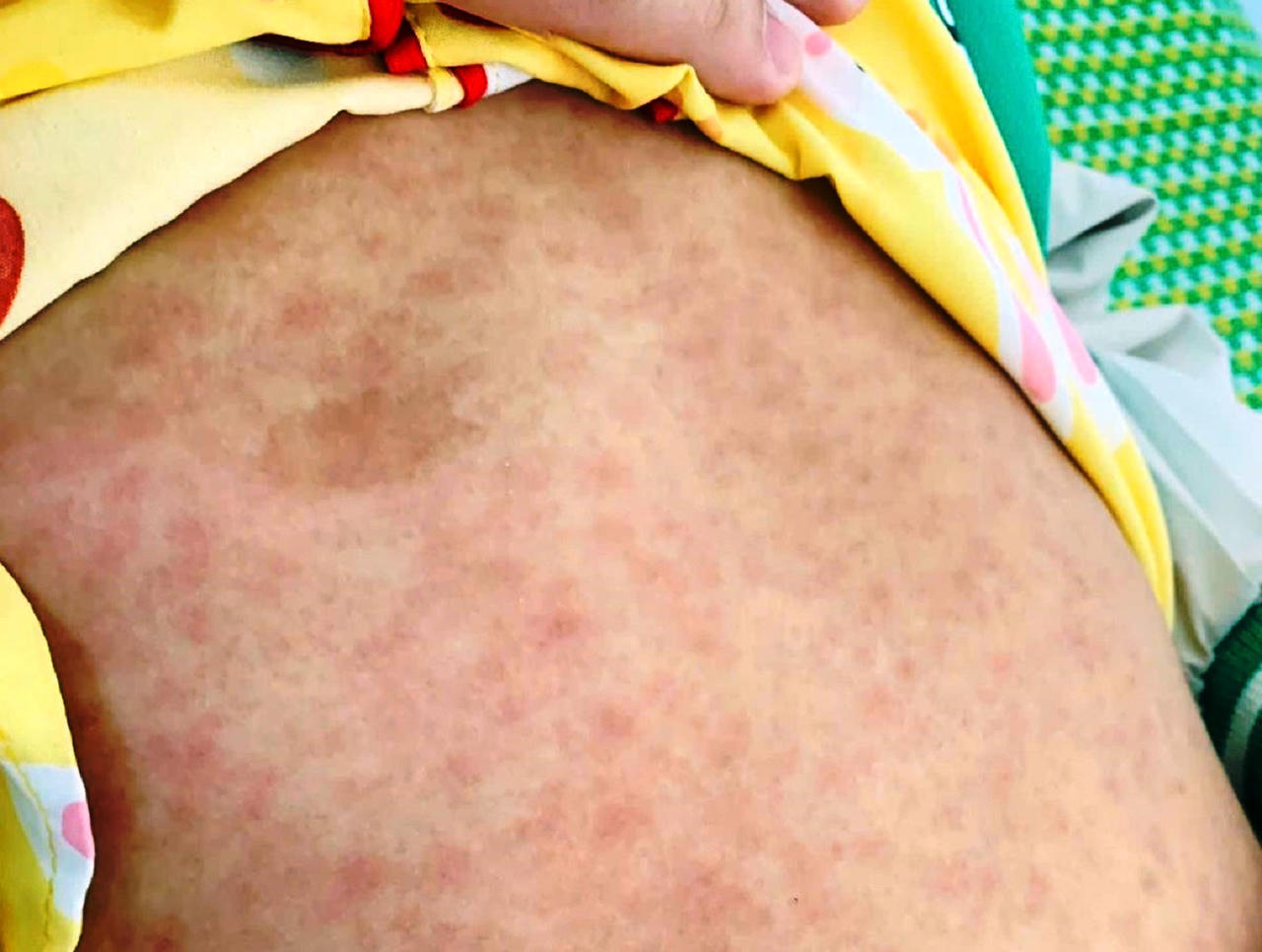 Hàng chục trẻ sốt phát ban, 3 bé tử vong tại huyện miền núi Quảng Nam