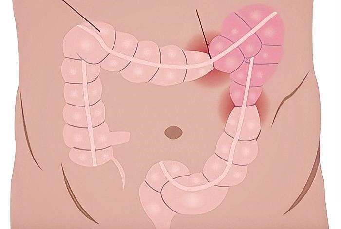 Chữa co thắt đại tràng tại nhà đơn giản, hiệu quả từ bí quyết của người Nhật